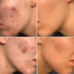 ژل ضدجوش دیفرین Adapalene 0.1% حجم 30 گرم - Image 4