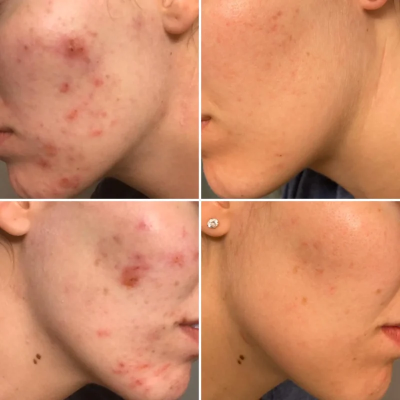 ژل ضدجوش دیفرین Adapalene 0.1% حجم 30 گرم - Image 4