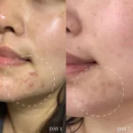 سرم ضدجوش اکسیس وای مدل Blemish Treatment حجم 15میل - Image 5