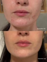 سرم میکرونیدلینگ ریدل شات وی تی کازمتیک مدل Reedle Shot100 - Image 7