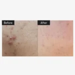 سرم میکرونیدلینگ ریدل شات وی تی کازمتیک مدل Reedle Shot100 - Image 2