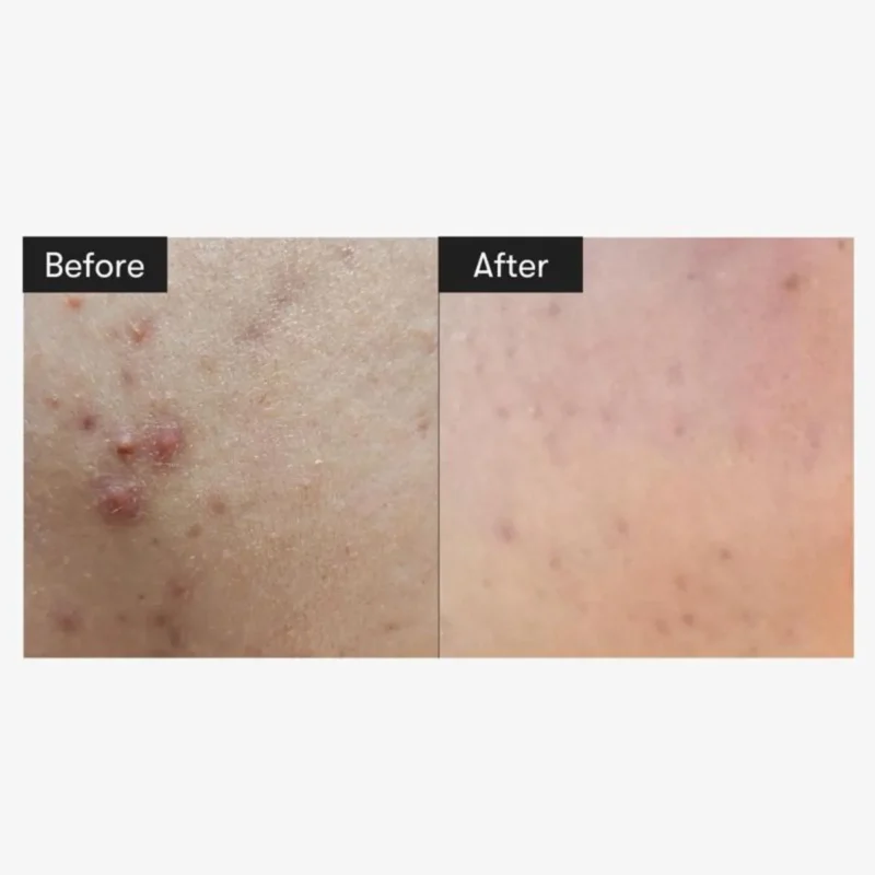 سرم میکرونیدلینگ ریدل شات وی تی کازمتیک مدل Reedle Shot100 - Image 2