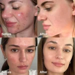 سرم ضد جوش مدیکیوب Succinic Acid Peel حجم ۵۰ گرم - Image 4
