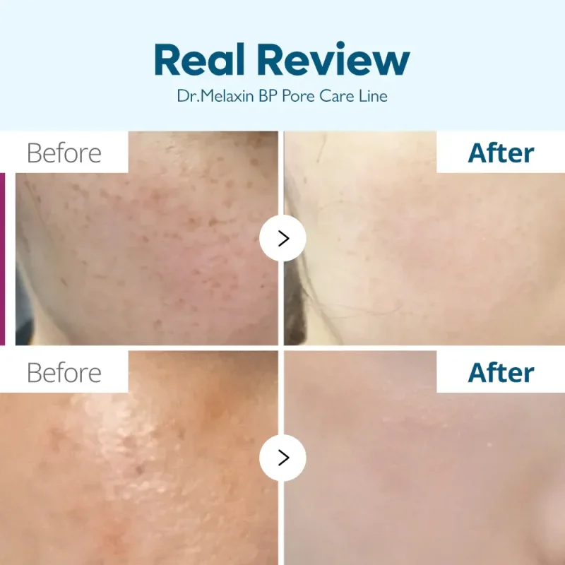 کرم ضدلک دکتر ملاکسین Tranexamic Acid حجم ۵۰ میل - Image 4